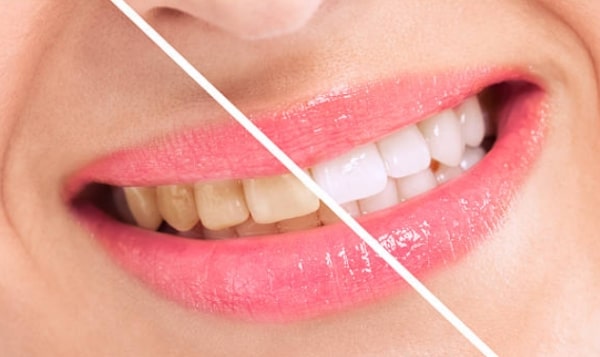 Sfaturi utile pentru dinții albi