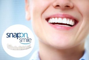 Snap-On Smile – Soluție rapidă pentru un zâmbet strălucitor! Recenzii clienti si pret!