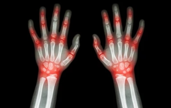 Care sunt cauzele artritei